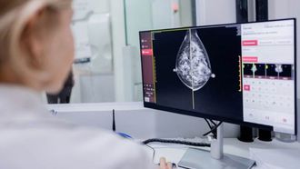 Ensayos prospectivos permitir�n comprobar si la cabergolina puede prevenir el c�ncer de mama.