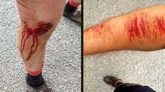 Feridas do ciclista arrollado en Goi�n (Sarria) por un coche que se deu � fuga