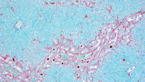 Fibrosis (rojo) en c�lulas del par�nquima hep�tico (azul) como respuesta a una lesi�n celular. / Paula S�nchez. CNIO