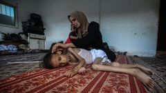 Una madre cuida a su hija desnutrida en Gaza