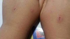 As� quedaron las manos del ni�o de ocho a�os que se enfrent� al juego del Abecedario