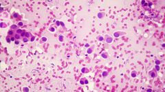 Imagen microsc�pica del c�ncer de mama.