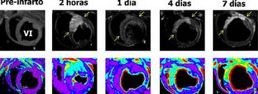 <span lang= es-es >Dos reacciones</span>. Las im�genes de resonancia magn�tica muestran diferentes momentos de la primera semana post-infarto del mismo paciente. Las flechas muestran la reacci�n inflamatoria del ventr�culo izquierdo (VI). Las im�genes de la fila inferior son las mismas que la de la superior, pero con otra secuencia que cuantifica la cantidad de agua en el tejido. Las im�genes recogen las dos ondas de reacci�n edematosa. 