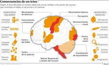 Consecuencias de un ictus