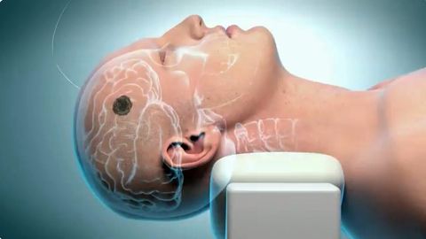 Terapia contra los tumores cerebrales investigado por el asturiano Juan Fueyo