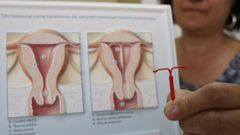 Un dispositivo intrauterino, en una imagen de archivo