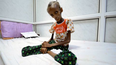 Una joven de 18 a�os afectada por una malnutrici�n severa en Yemen.