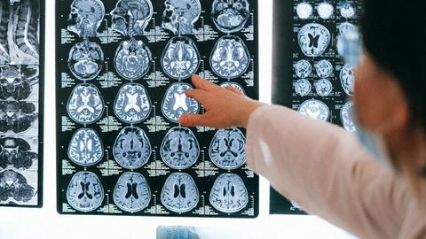 Imagen de archivo de resonancias magn�ticas del cerebro