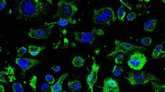 Imagen de agregados de la prote�na TDP-43 (verde) fuera de los n�cleos (azul) en los linfocitos de pacientes de ELA