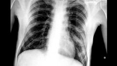 As� fue la primera radiograf�a del m�dico del CHUO tras dar positivo por coronavirus