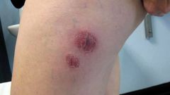 Piel infectada por la bacteria