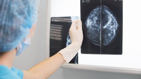 Resultado de una mamografía.