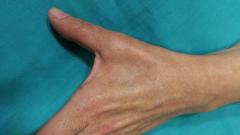 El s�ndrome del t�nel carpiano produce un dolor intenso, sobre todo por la noche, disminuci�n de la sensibilidad y, en casos extremos, tambi�n de la movilidad