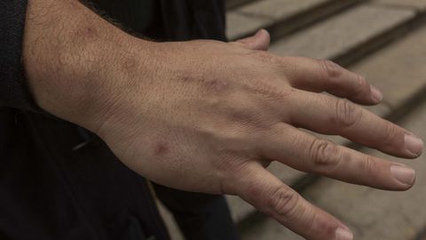 Foto de la mano donde se aprecian las picaduras de chinches