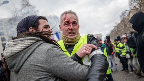 Uno de los heridos durante los enfrentamientos entre manifestantes y fuerzas del orden en Par�s, en los que otro manifestante perdi� una mano