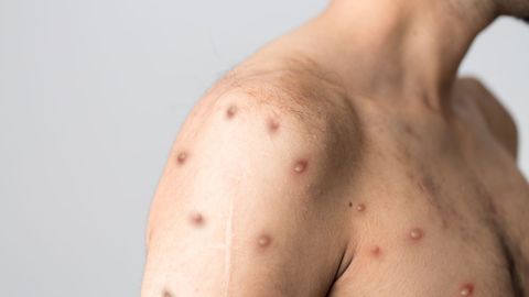 Imagen de archivo de un paciente con�el virus de�mpox