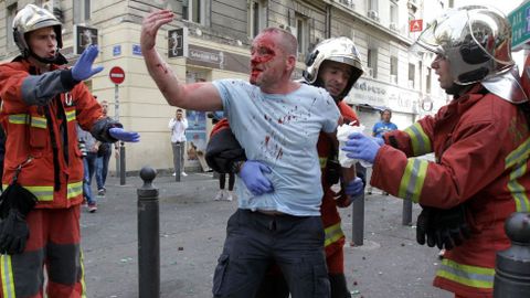 �Hooligan� ingl�s con la cara destrozada despu�s de ser agredido por un grupo de ultras rusos. 