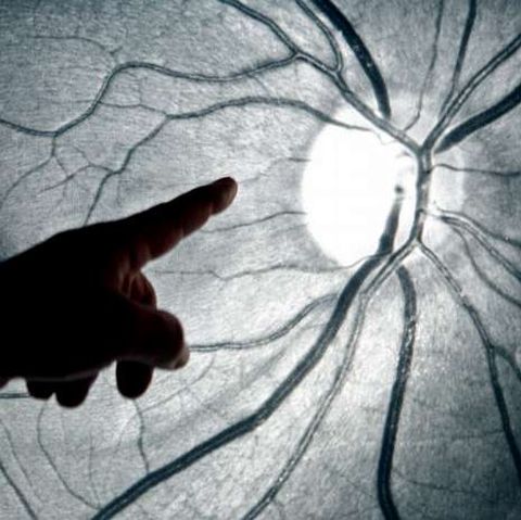 El glaucoma es una enfermedad del nervio �ptico. 