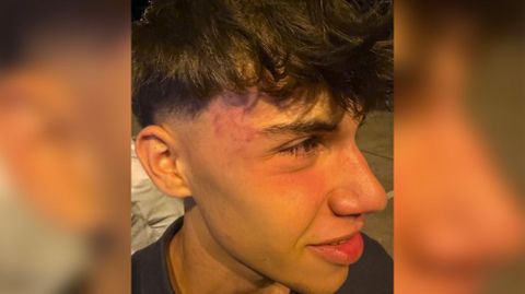 Más marcas en la cara después de la agresión que denunció este joven.