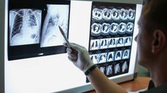 Radiograf�a de un paciente con tuberculosis