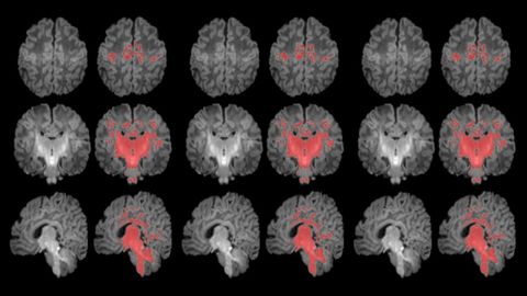 Un estudio mide con resonancia magntica la mielinizacin cerebral de los recin nacidos