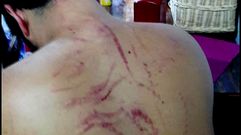 Estado en el que qued� la espalda del joven agredido en una paliza en La Corredoria.Estado en el que qued� la espalda del joven agredido en una paliza en La Corredoria