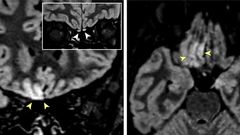 Im�genes obtenidas por resonancia magn�tica en las que los especialistas se�alan alteraciones en la zona del cerebro asociada a la percepci�n del olfato