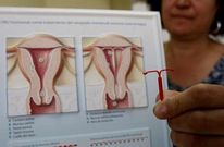 El abanico de m�todos se cierra cada vez m�s en torno al dispositivo intrauterino.