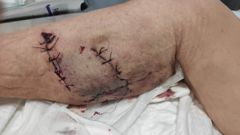 Feridas causadas pola mordedura dun can a unha muller na Fonsagrada