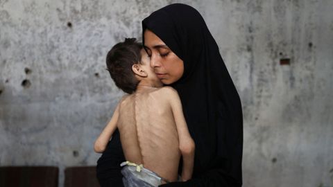 Una mujer sostiene a su hijo, que sufre desnutrición, en un refugio de Ciudad de Gaza