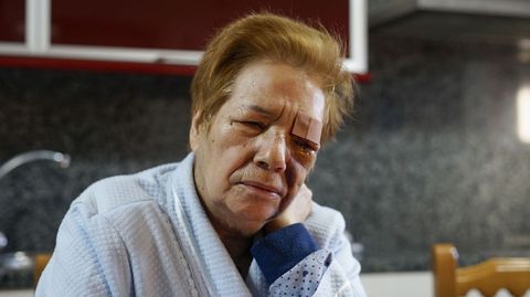 Feliciana Romero, atacada por tres pit bull en un pueblo de Muos.