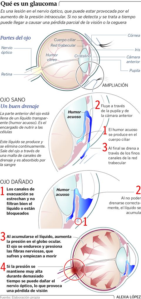 Qu� es un glaucoma