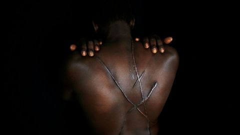 Hassan Mekki, un inmigrante sudan�s de 32 a�os, muestra las cicatrices de su espalda  