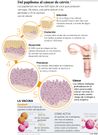 Del papiloma al c�ncer de c�rvix