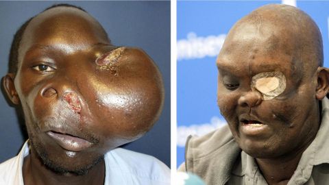 El antes y despu�s de la extracci�n de un tumor gigante