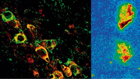 Neuronas afectadas, a la izquierda, y reducci�n progresiva de la prote�na clave en la enfermedad tras el tratamiento (derecha)