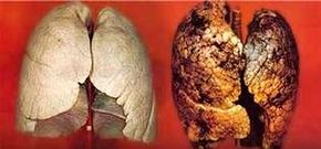 Las im�genes muestran las diferencias entre un pulm�n sano -izquierda- y otro afectado por el c�ncer