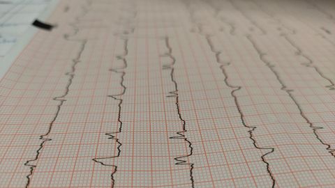 Imagen de archivo de un electrocardiograma.