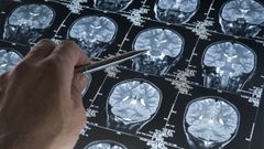 Un m�dico revisa las im�genes del cerebro obtenidas de una resonancia para comprobar si un paciente tiene alzh�imer