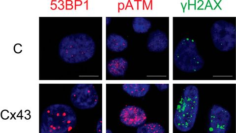 Microscop�a de fluorescencia de c�lulas tumorales en cultivo, en ausencia (arriba) y presencia (abajo) de conexina 43. La expresi�n de conexina 43 se asocia con un aumento en los niveles de da�o en el ADN. En azul, el n�cleo celular, donde se localiza el ADN.
