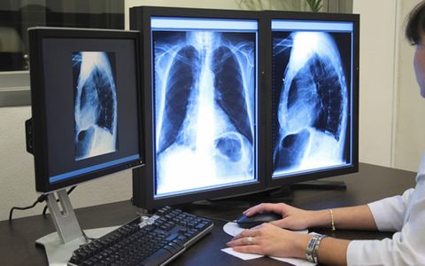 cancerdepulmonh
