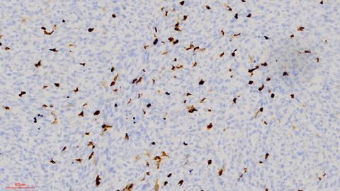 La infiltraci�n de c�lulas del sistema inmunol�gico (marr�n) en los tumores de ratones.