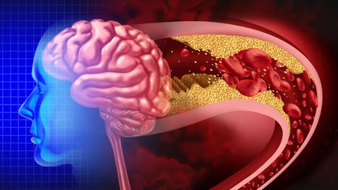 Ilustración para reflejar como se produce una arterioesclerosis en el cerebro que puede desencadenar un ictus