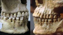 El crneo de una antigua cazadora-recolectora de Rumania (izquierda) carece de una sobremordida observada en el crneo de un griego de hace 2.500 aos