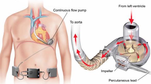 El HUCA implanta por primera vez un coraz�n artificial.El HUCA implanta por primera vez un coraz�n artificial 