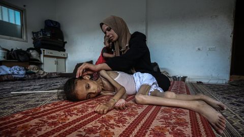 Una madre cuida a su hija desnutrida en Gaza