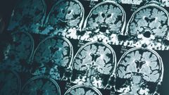 Resonancia magntica para detectar el alzhimer