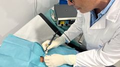 Con ese tipo de cirugas menores se eliminan quistes epidrmicos, verrugas o furnculos