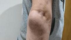 El vecino de Burela afirma que acudi� hasta en tres ocasiones al PAC de Burela para recibir asistencia antes de acudir a las urgencias hospitalarias