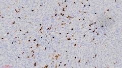 La infiltraci�n de c�lulas del sistema inmunol�gico (marr�n) en los tumores de ratones.